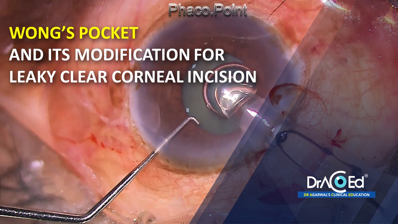 WONG’S POCKET AND ITS MODIFICATION FOR LEAKY CLEAR CORNEAL INCISION